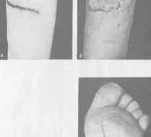 Ožiljak deformitet stopala i gležnja. Čir na taban stopala luka