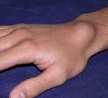 Sarkom mekog tkiva na ruku i ručni zglob područje: uzroci, obrada