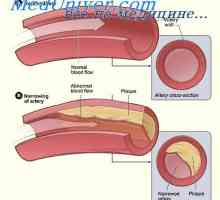 Familijarne hiperkolesterolemije. Faktori rizika za aterosklerozu