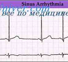 Srčane aritmije. Povreda ritma sinusnog čvora