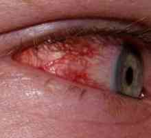 Simpatička oftalmia: simptomi, dijagnoza, liječenje