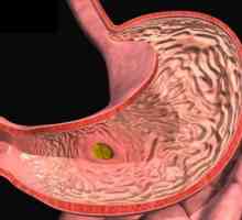 Simptomi gastritisa i liječenje