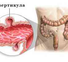 Simptomi i liječenje diverticulosis od sigmoidalne debelog crijeva