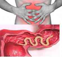 Simptomi i liječenje crijevnih crva (crijevna glista helmintski invazija) u odraslih