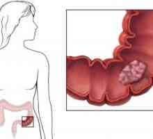 Simptomi polipa u debelom crijevu