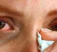 Suzenje očiju: liječenje, uzroci, simptomi, znakovi