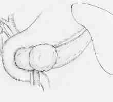 Pseudopapillary-čvrsti tumor gušterače