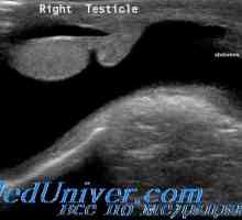 Spermatocele i hydrocele u djece. tumori testisa