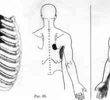 Bol u leđima uzrokovane prednji nazupčani mišić