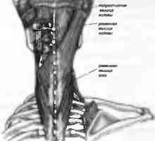 Bol u leđima uzrokovana mišićnom pojas