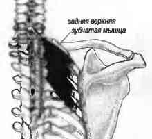 Bol u leđima uzrokovana serratus