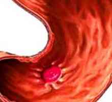 Gastritis faza početnik, pogoršanje, remisije i protok iz pogoršanje