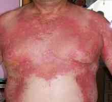 Stafilokokni sindrom oparen kože: liječenje, uzroci, simptomi, znakovi