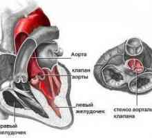 Aortalni stenoza, usta, liječenje, uzroci, simptomi, znakovi