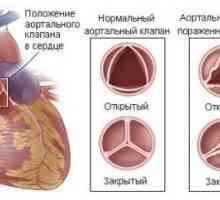 Aortalni stenoza