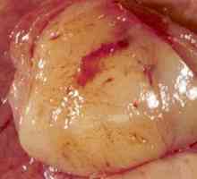 Želudac gastrointestinalnog stromalnog tumora (GIST, pov)