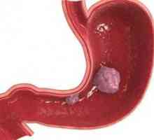 Stromalnih tumora gastrointestinalnog trakta: simptomi, liječenje, simptoma