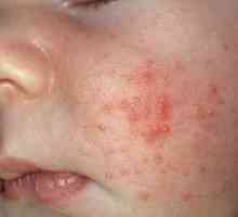 Glavni znakovi alergije u dojenčadi. Uzroci alergije kod djece. Kako prepoznati i liječiti alergije…
