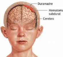 Subduralni hematom mozak: implikacije za liječenje