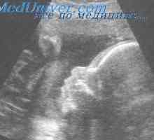 Supraventrikularne tahiaritmije fetus. Dijagnoza fetalnih tahiaritmija