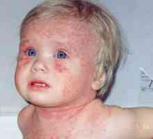 Osip kod djece u dysbacteriosis