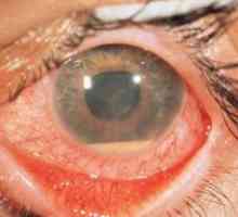 Toksoplazmoza retinohorioidit