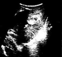 Transvaginalni ultrazvuk dijagnostika postporođajne endometrioza
