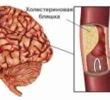 Prolaznog ishemijskog napada: simptomi, liječenje, posljedice