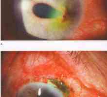 Trauma rožnice korneosklerični razmak i rana dehiscence