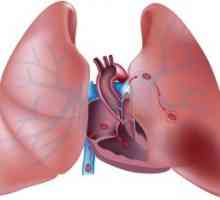 Plućna embolija: liječenje, simptomi, uzroci, simptomi, dijagnoza