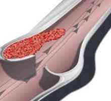 Tromboza krvi: oblici, što je to, klasifikacija