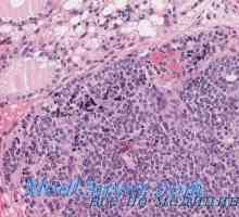Tuberkuloza morfologije štitnjače, patološko anatomija