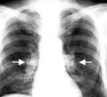 Tuberkuloza intratorakalnih limfnih čvorova: liječenje, komplikacije, uzroci, simptomi