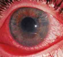 Uveitis očiju: liječenje, simptomi, uzroci, simptomi, dijagnoza