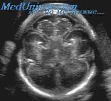Prenatalna skrb s ventriculomegaly. kongenitalna hidrocefalus