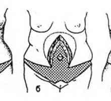 Vertikalni Abdominoplastika. Značajke Abdominoplastika ako postoji ožiljaka od prednjeg trbušnog…
