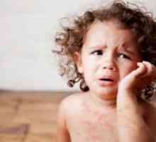 Virusne bolesti u djece, u pratnji osip