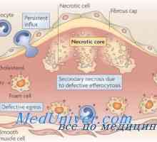 Učinak hipotalamusa metabolizam lipida. Ateroskleroze kod sindroma diencephalic
