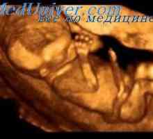 Kongenitalna amputacija fetusa. Sindrom aglossia-adactylia