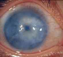 Sekundarni glaukom očiju: liječenje, uzroci, klasifikacija, simptomi, znakovi