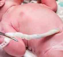Prolapsa pupkovine pri rođenju: efekti, uzroci