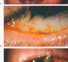 Bolesti spojnice očni rosacea