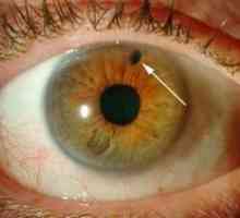 Glaukom kut-zatvarač: liječenja, simptomi, uzroci, simptomi