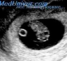 Značenje zygosity. Značenje korionski višestruke trudnoće