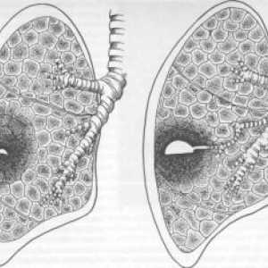 Pluća absces: simptomi, liječenje, dijagnoza, komplikacije, uzroci, simptomi