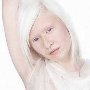 Albinizam kod ljudi, oka