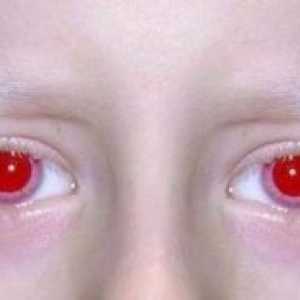 Albinizam za ljude: simptomi, uzroci, simptomi, liječenje