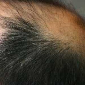 Alopecija Kosa: liječenje, uzroci, simptomi, znakovi