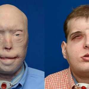 Američki kirurzi obavili transplantaciju spaljene face vatrogasac