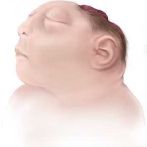 Anencefalija fetus: uzroci, simptomi